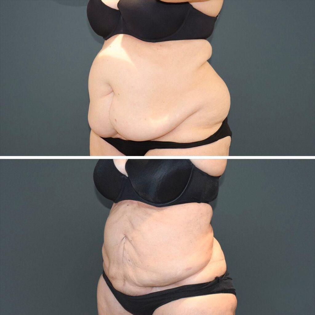 Sydney Megaliposuction Stomach Female 2021 Right Sm Before And After