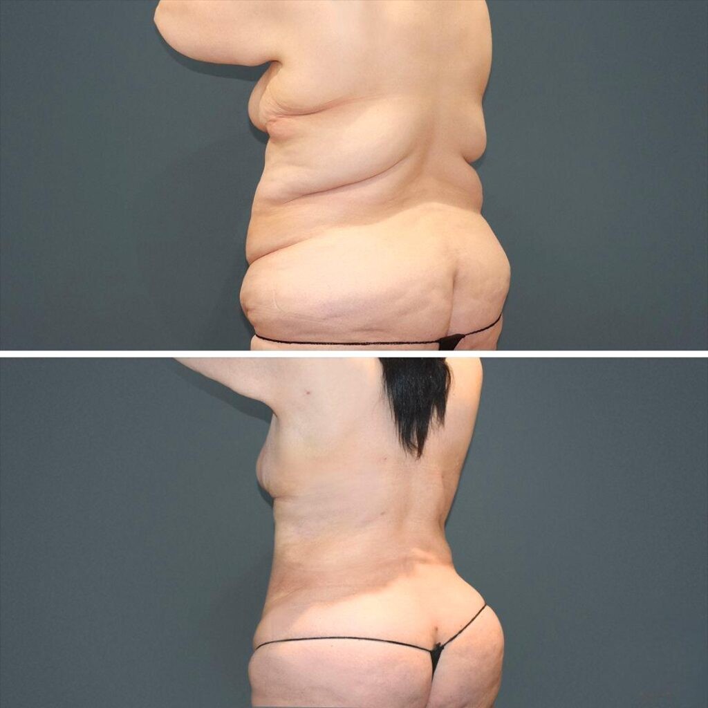 Sydney Megaliposuctionback Female 2021 Right Am Before And After