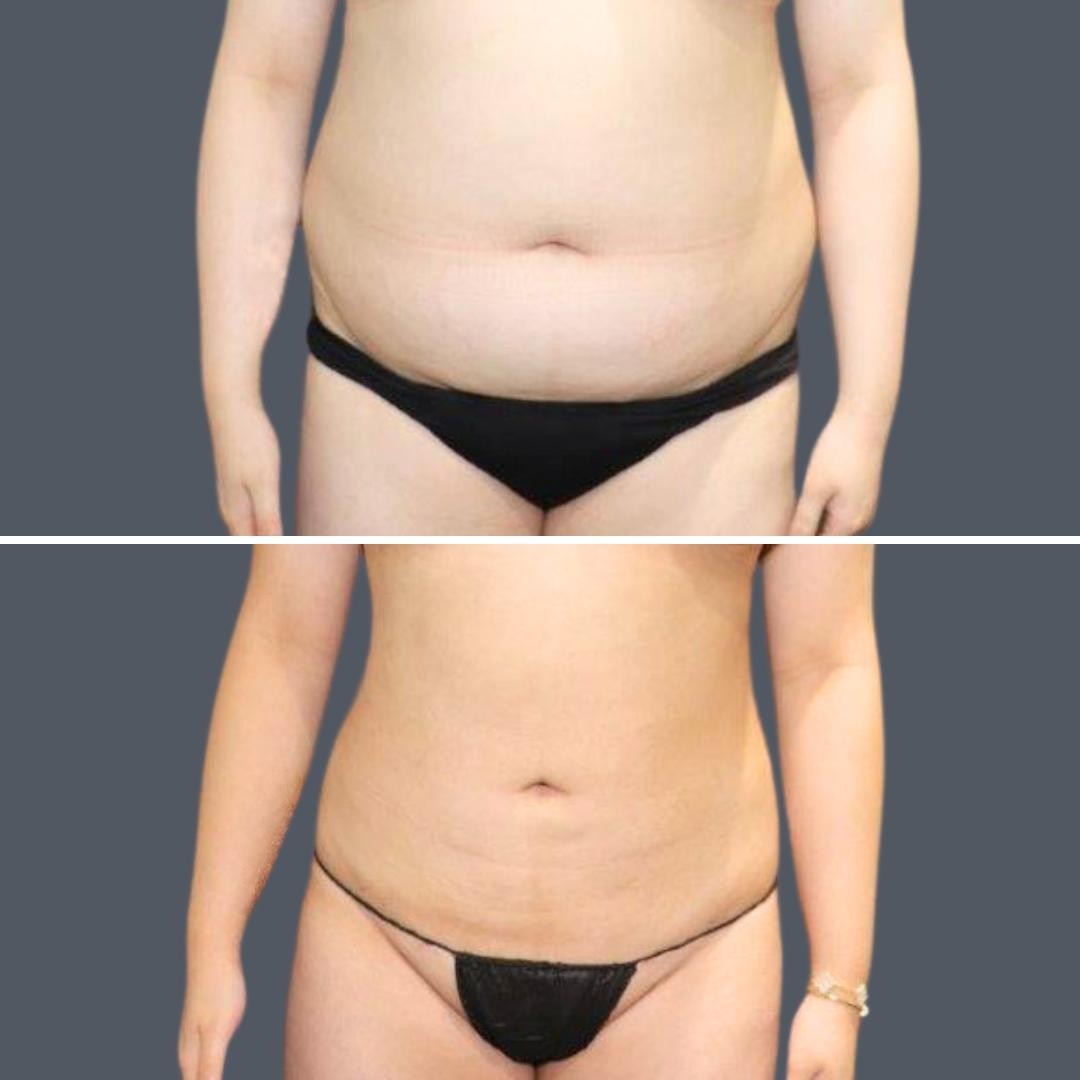 Male Vaser Liposuction