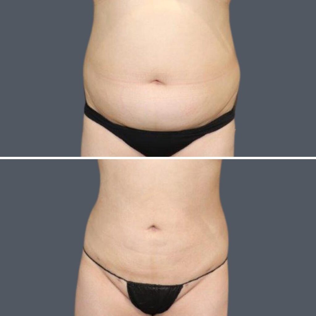 Sydney Stomach Liposuction Female 2024 Sg 002 Before And After