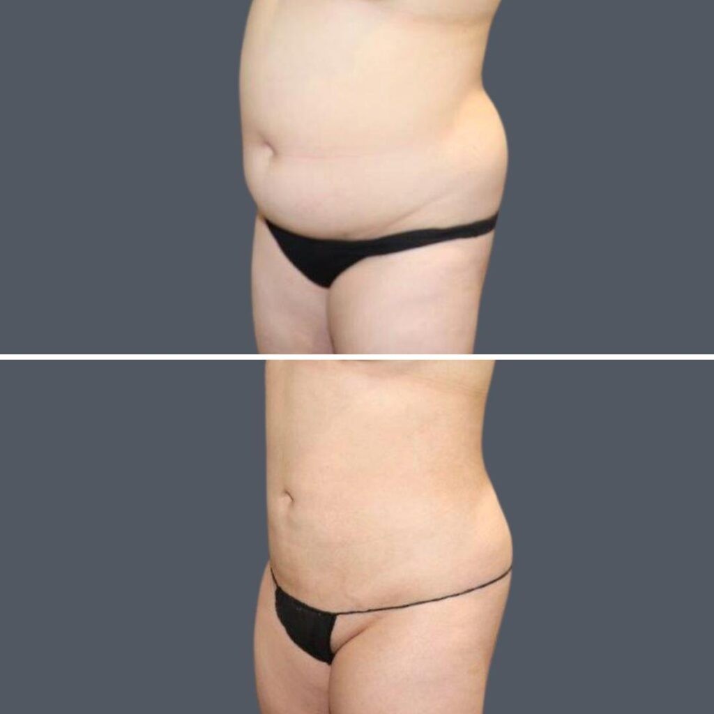 Sydney Stomach Liposuction Female 2024 Sg 003 Before And After