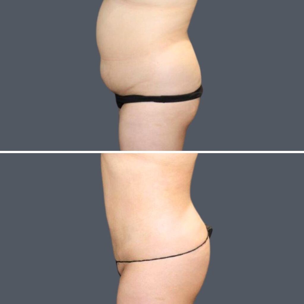 Sydney Stomach Liposuction Female 2024 Sg 004 Before And After