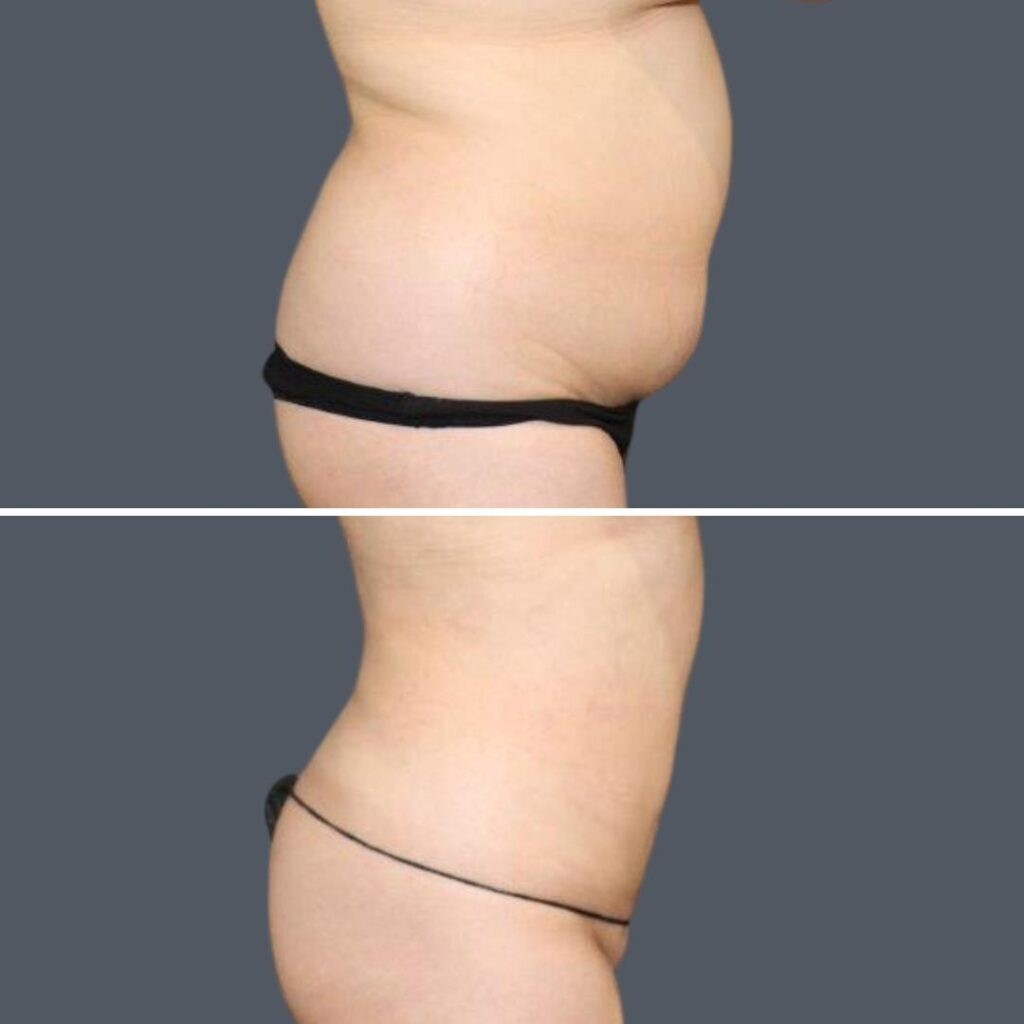 Sydney Stomach Liposuction Female 2024 Sg 009 Before And After