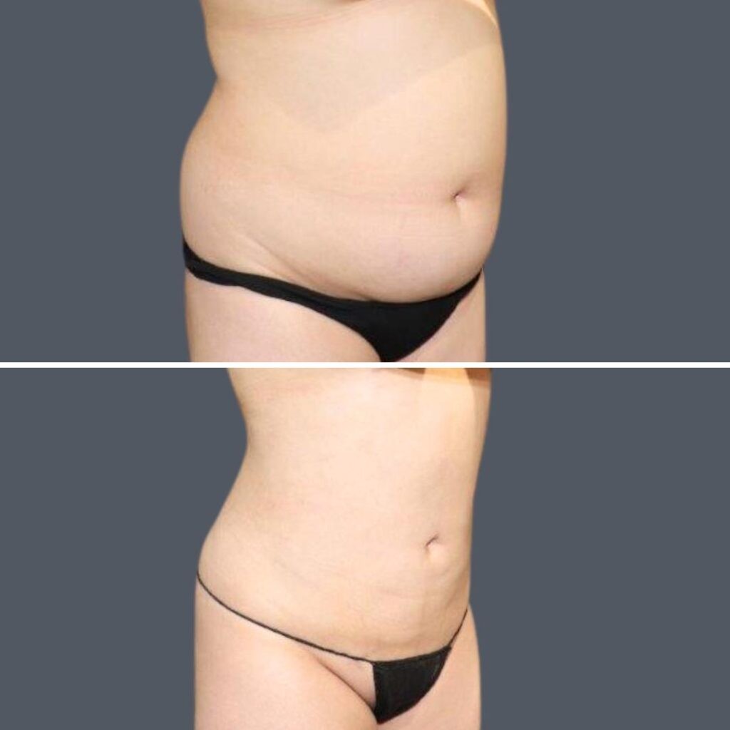 Sydney Stomach Liposuction Female 2024 Sg 010 Before And After
