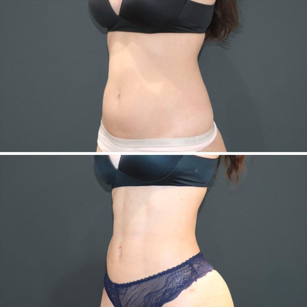 Sydney Vaserhidefliposuction Stomach Female 2021 Right Re Before And After