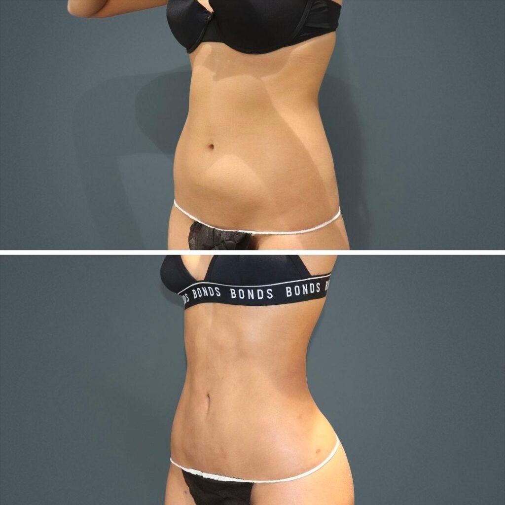 Sydney Vaserhidefliposuction Stomach Female 2021 Right Sm Before And After