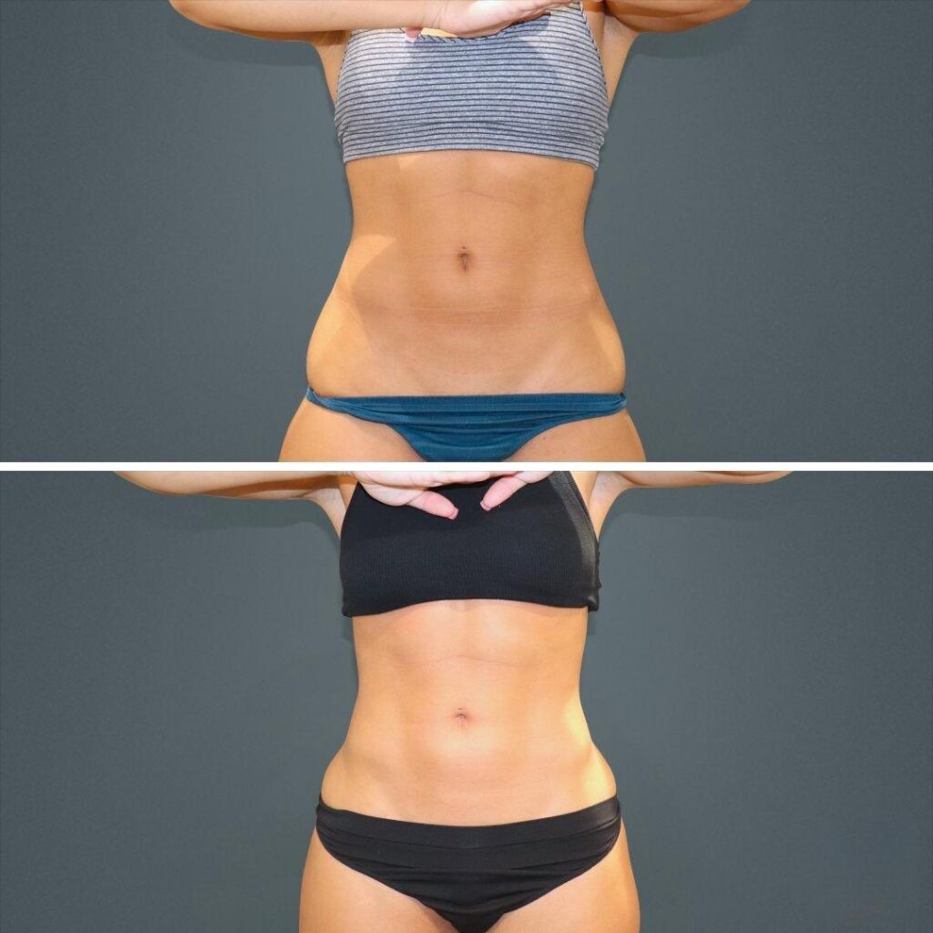 Sydney Vaserhidefliposuction Stomach Female 2022 Front Rc Before And After