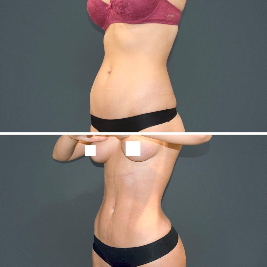 Sydney Vaserhidefliposuction Stomach Female 2022 Right Rl Before And After