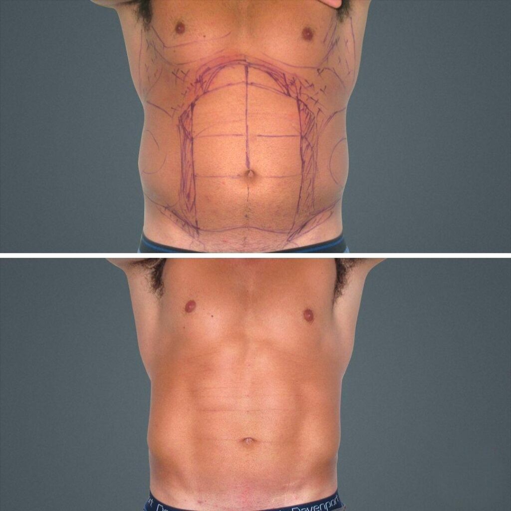 Sydney Vaserhidefliposuction Stomach Male 2021 Front Rn Before And After