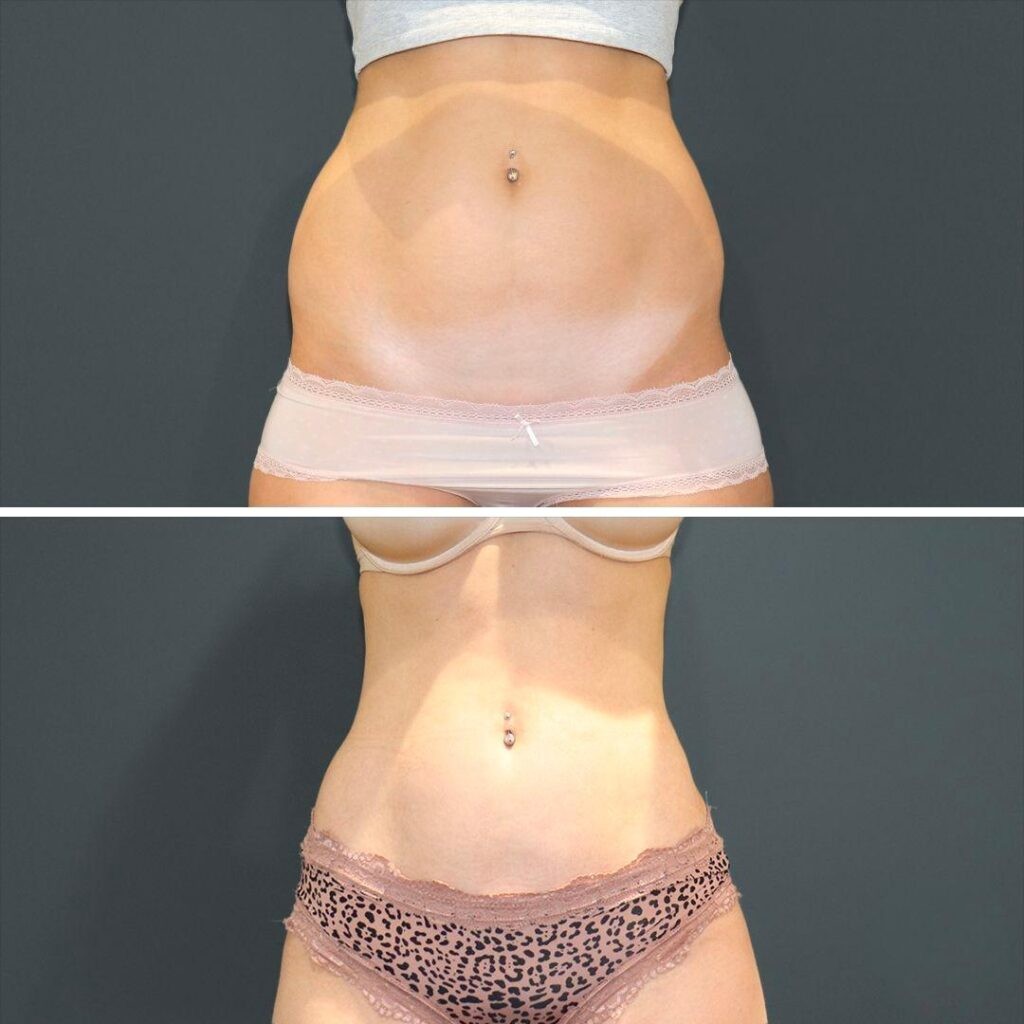 Sydney Vaserliposuction Stomach Female 2021 Right Ma Before And After