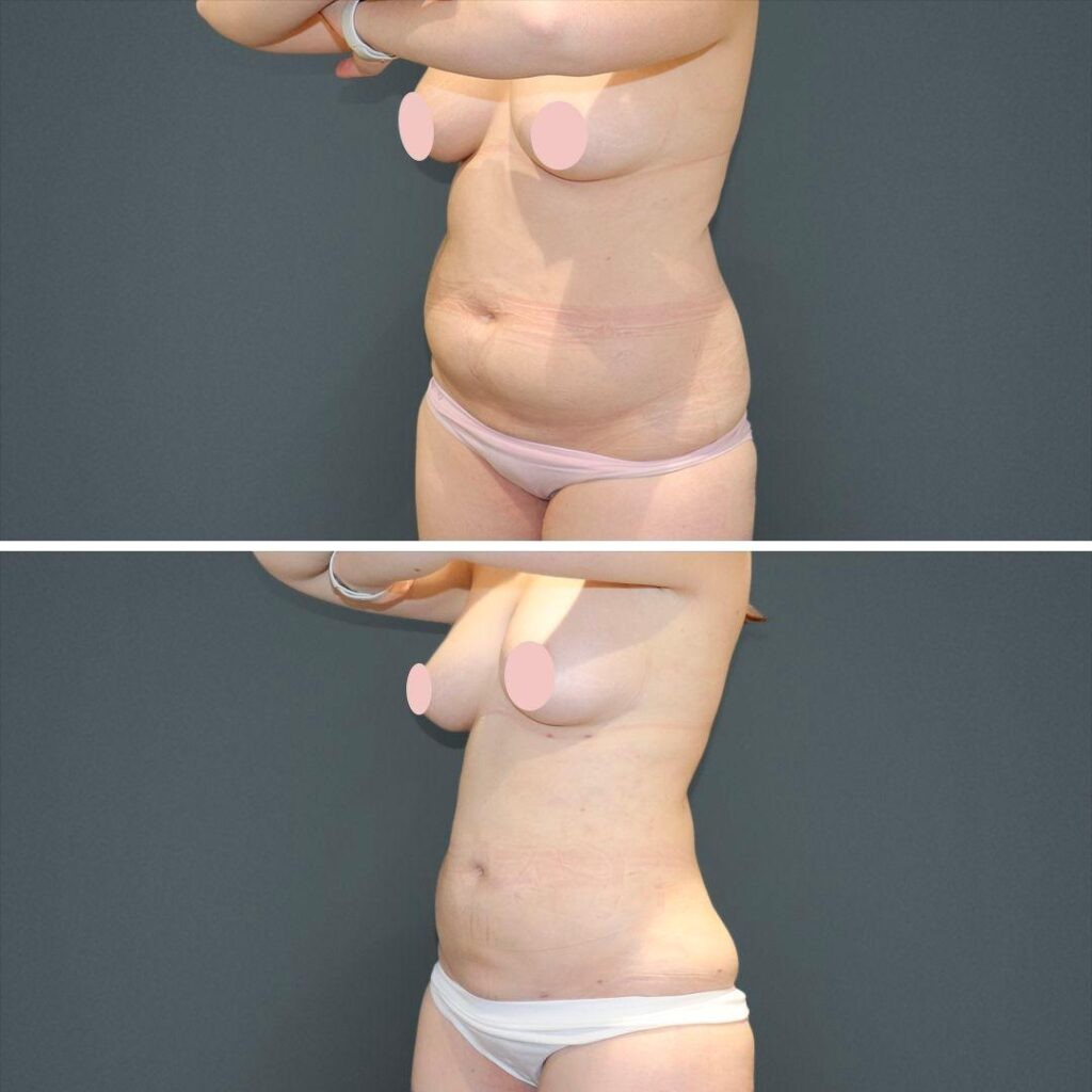 Sydney Vaserliposuction Stomach Female 2022 Front Ll Before And After