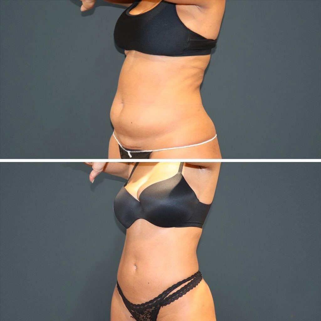 Sydney Vaserliposuction Stomach Female 2022 Right Mc Before And After
