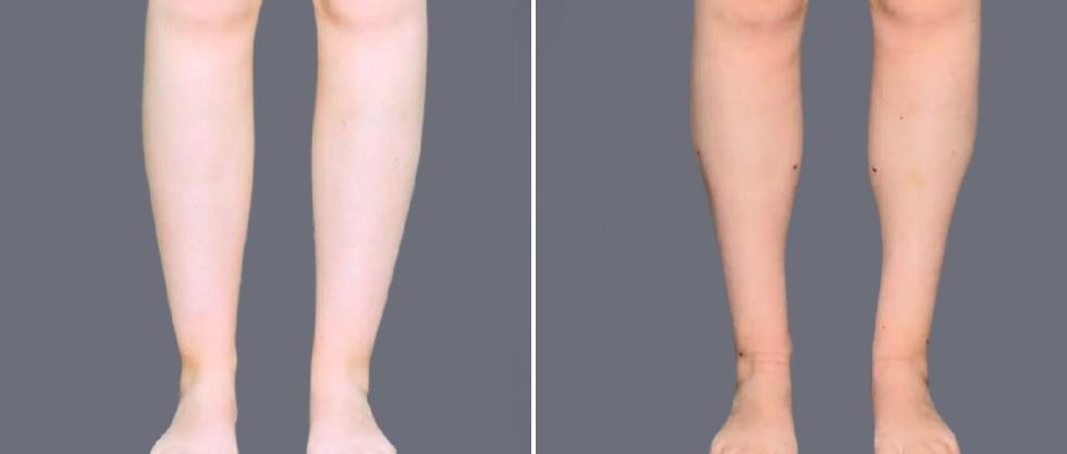 Vaser Ankleliposuction Female Pre2024 001 Before And After