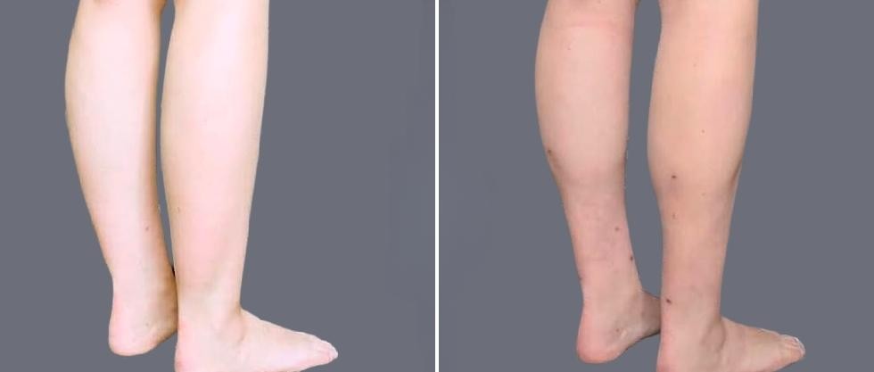 Vaser Ankleliposuction Female Pre2024 002 Before And After