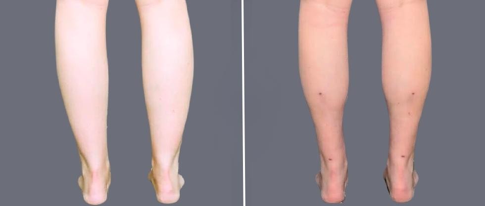Vaser Ankleliposuction Female Pre2024 003 Before And After