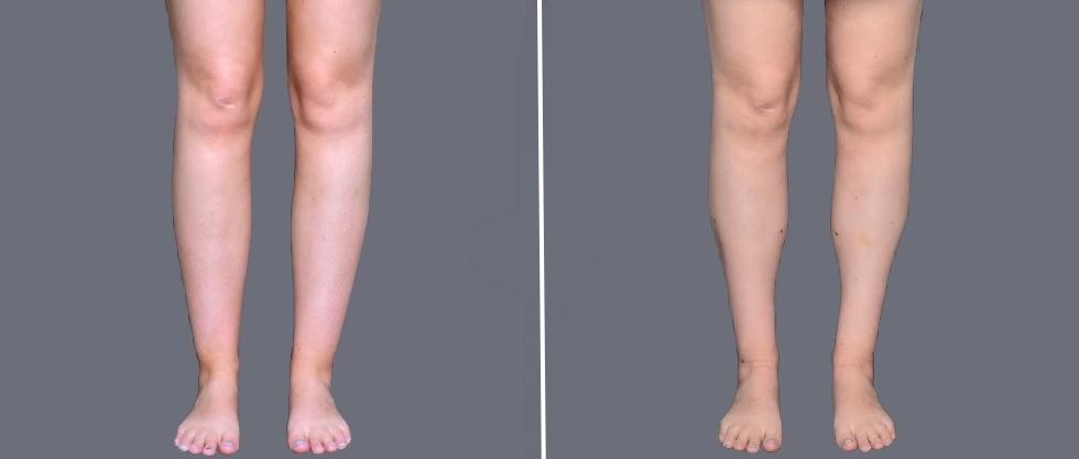Vaser Ankleliposuction Female Pre2024 004 Before And After