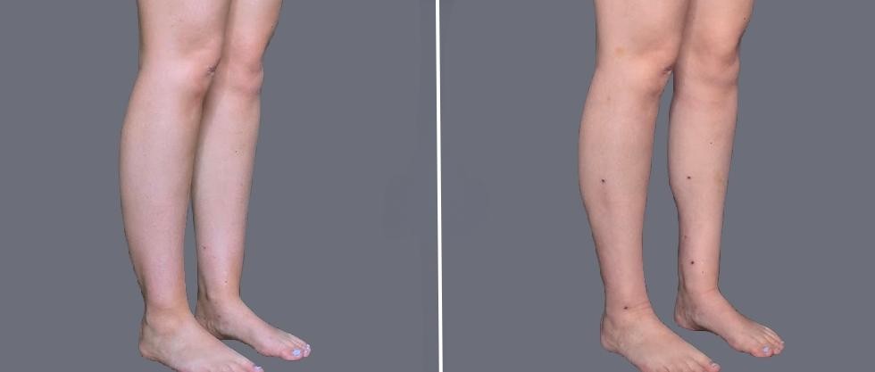 Vaser Ankleliposuction Female Pre2024 005 Before And After