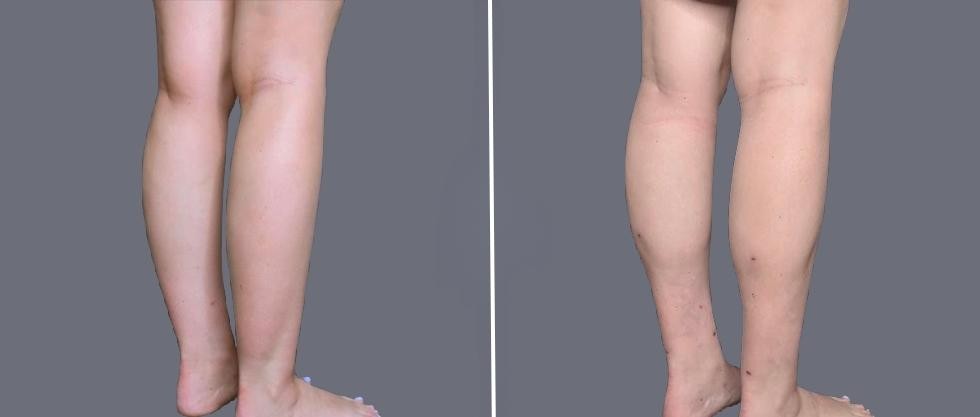 Vaser Ankleliposuction Female Pre2024 006 Before And After