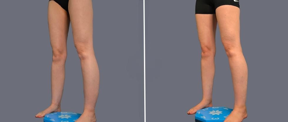 Vaser Ankleliposuction Female Pre2024 007 Before And After