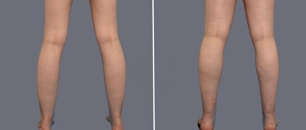 Vaser Ankleliposuction Female Pre2024 008 Before And After