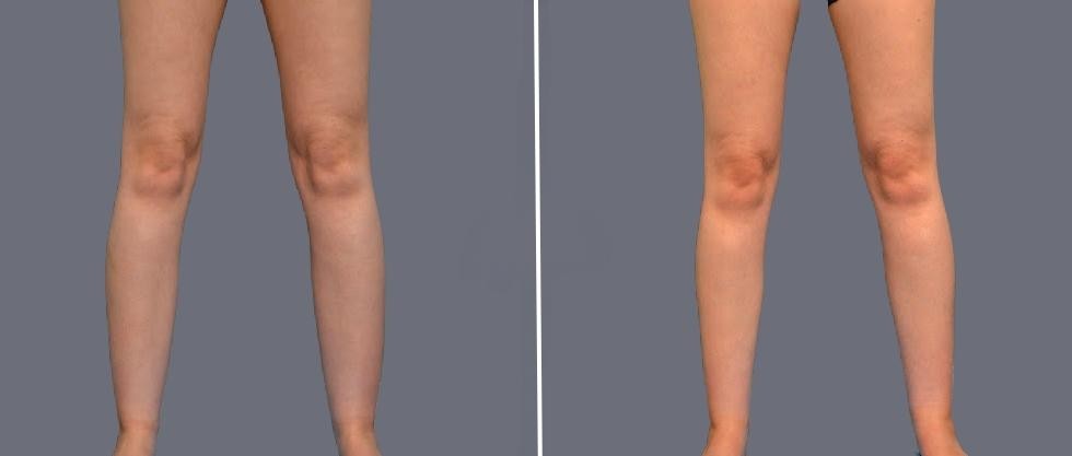 Vaser Ankleliposuction Female Pre2024 009 Before And After