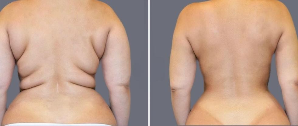 Vaser Back Liposcution Female Pre2024 001 Before And After