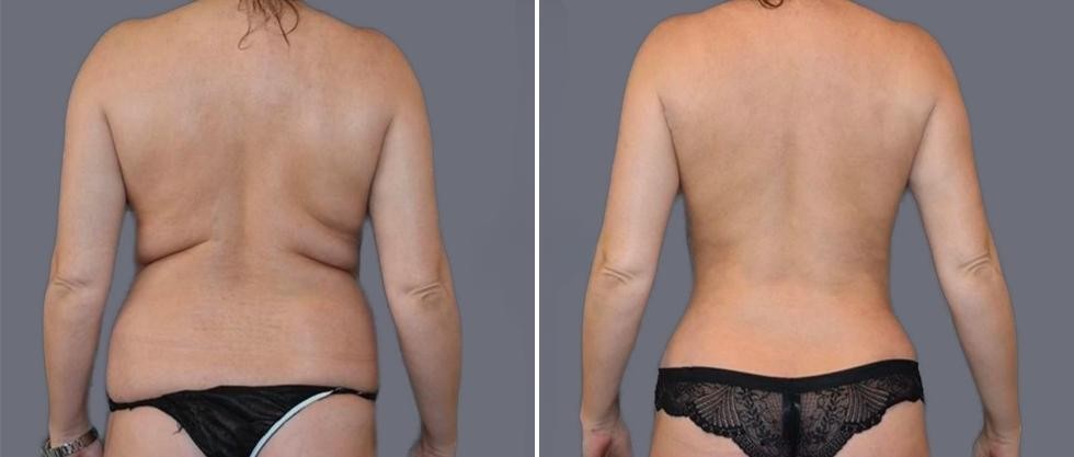 Vaser Back Liposcution Female Pre2024 002 Before And After