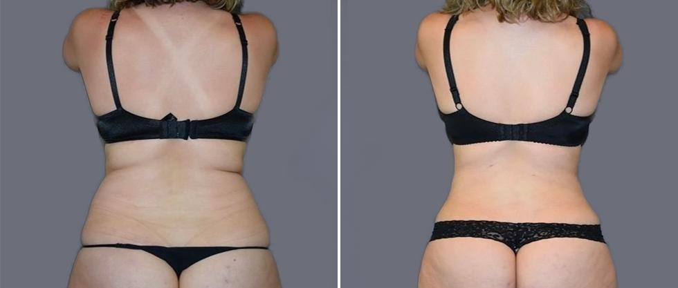 Vaser Back Liposcution Female Pre2024 003 Before And After