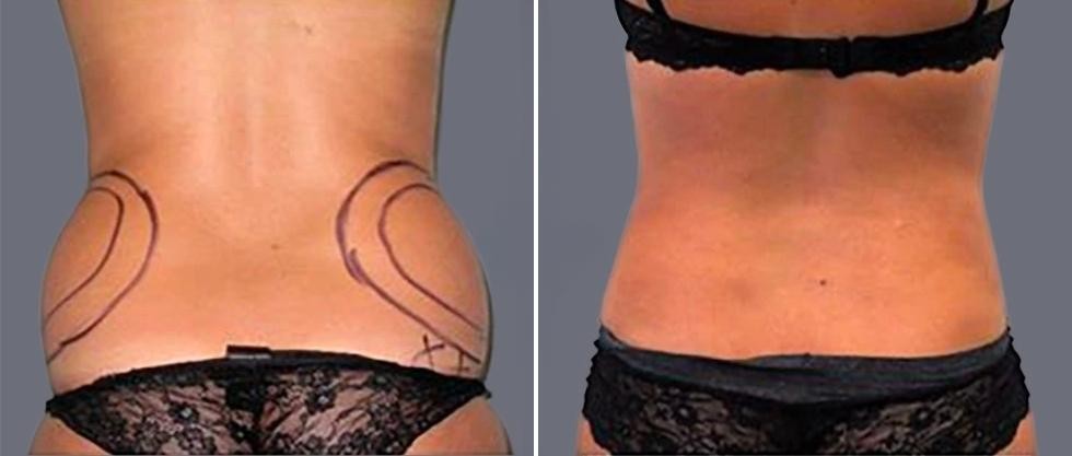 Vaser Back Liposcution Female Pre2024 004 Before And After