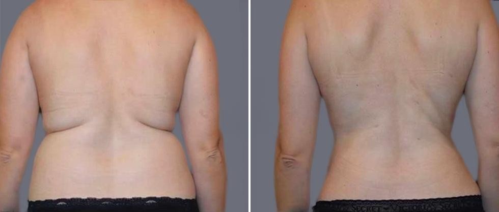 Vaser Back Liposcution Female Pre2024 005 Before And After