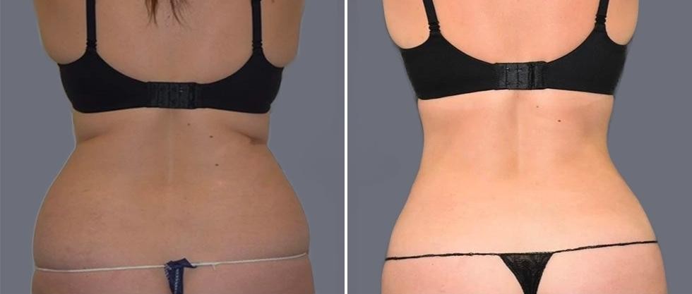 Vaser Back Liposcution Female Pre2024 006 Before And After