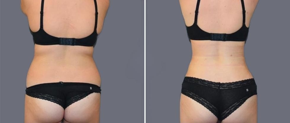 Vaser Back Liposcution Female Pre2024 007 Before And After
