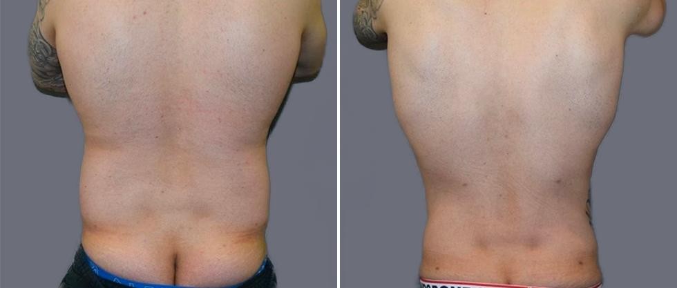 Vaser Back Liposcution Male Pre2024 001 Before And After