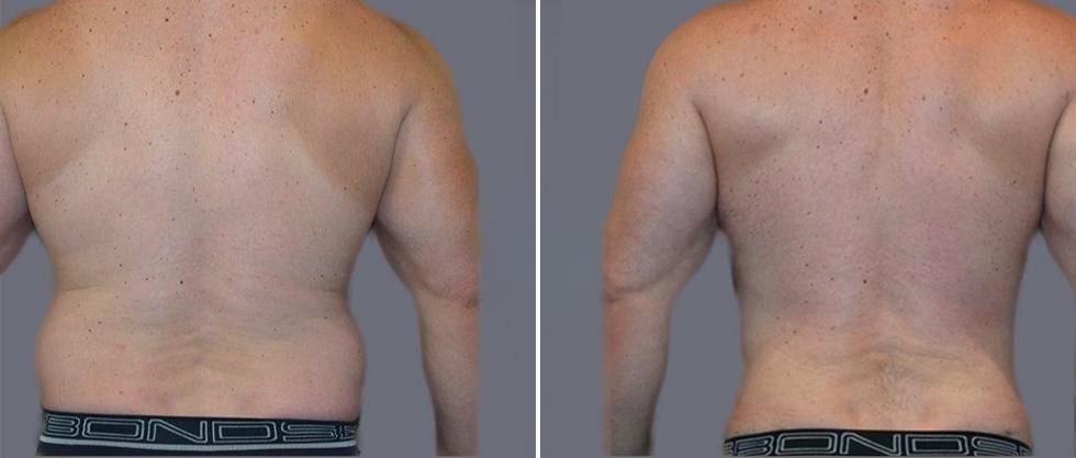 Vaser Back Liposcution Male Pre2024 002 Before And After