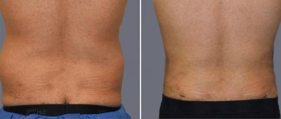 Vaser Back Liposcution Male Pre2024 003 Before And After