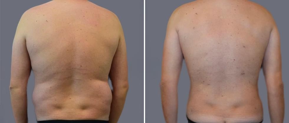 Vaser Back Liposcution Male Pre2024 004 Before And After