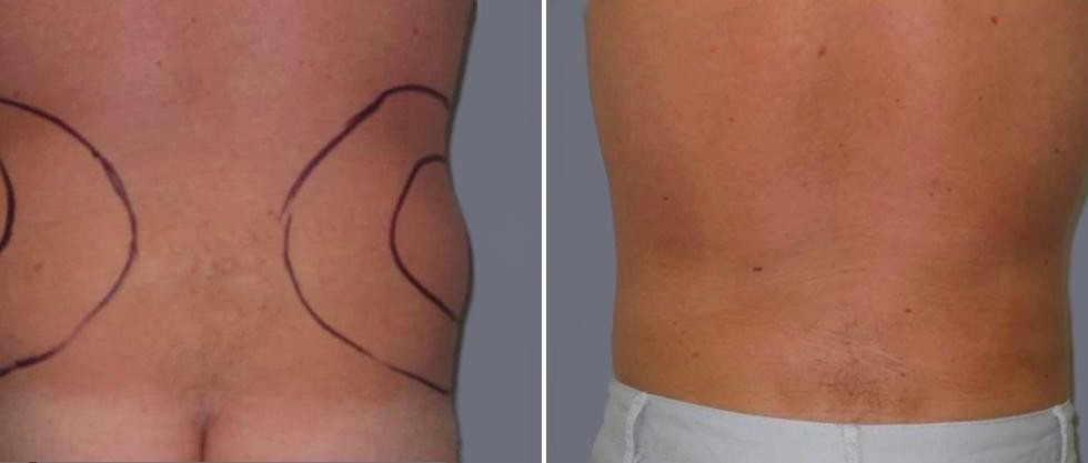 Vaser Back Liposcution Male Pre2024 005 Before And After