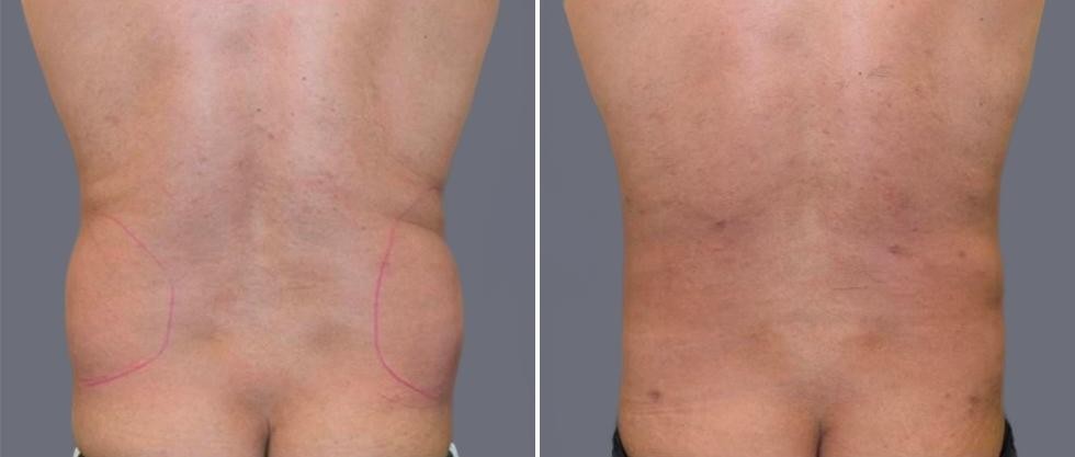 Vaser Back Liposcution Male Pre2024 006 Before And After