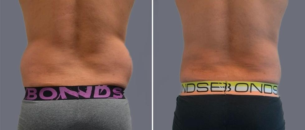 Vaser Back Liposcution Male Pre2024 007 Before And After