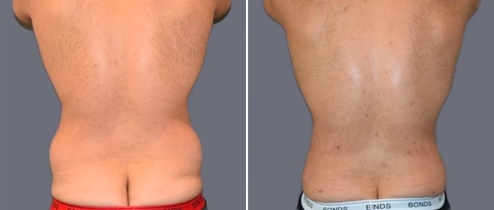 Vaser Back Liposcution Male Pre2024 008 Before And After