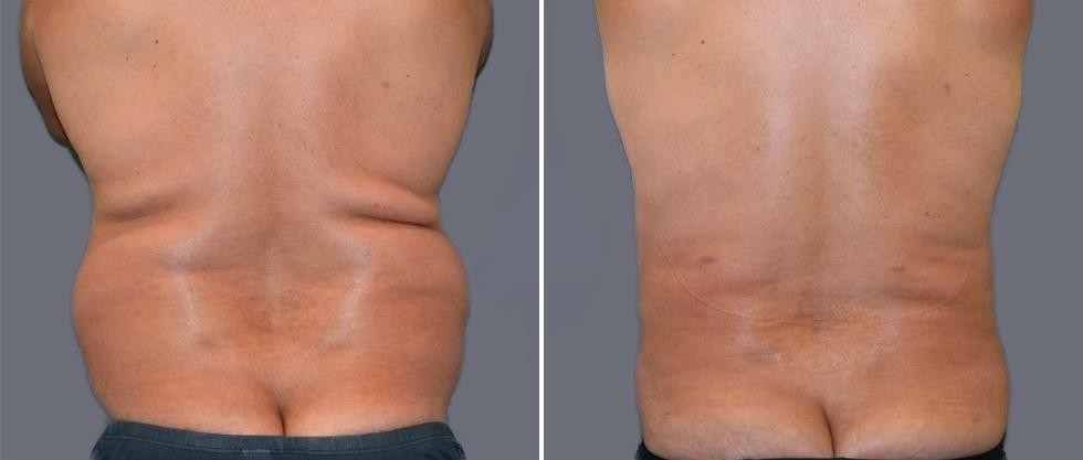 Vaser Back Liposcution Male Pre2024 009 Before And After