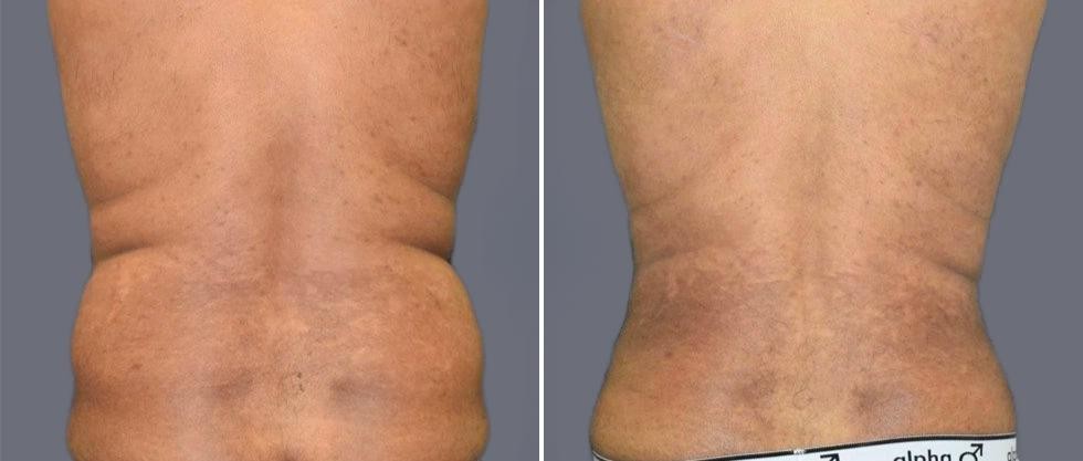 Vaser Back Liposcution Male Pre2024 010 Before And After