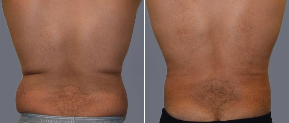 Vaser Back Liposcution Male Pre2024 011 Before And After