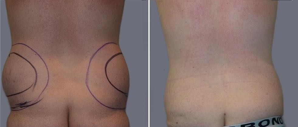 Vaser Back Liposcution Male Pre2024 012 Before And After