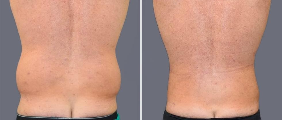 Vaser Back Liposcution Male Pre2024 013 Before And After