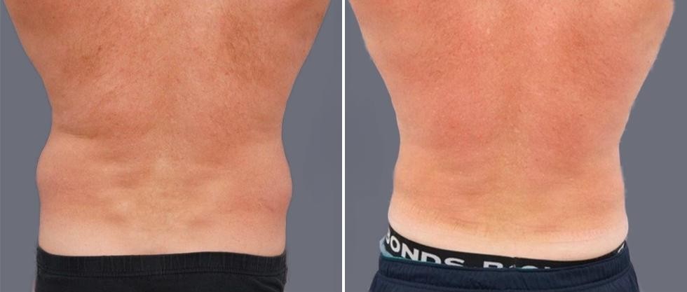 Vaser Back Liposcution Male Pre2024 014 Before And After