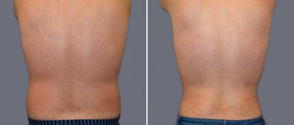 Vaser Back Liposcution Male Pre2024 015 Before And After