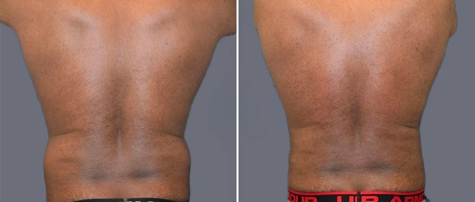 Vaser Back Liposcution Male Pre2024 016 Before And After