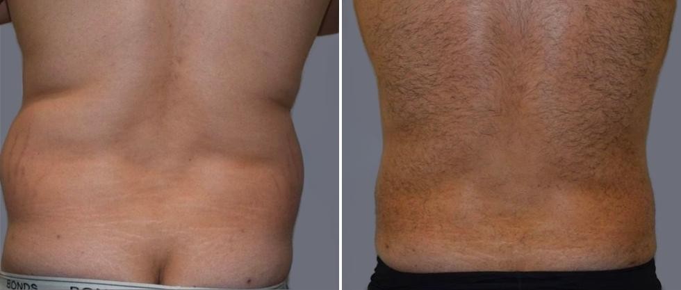 Vaser Back Liposcution Male Pre2024 017 Before And After