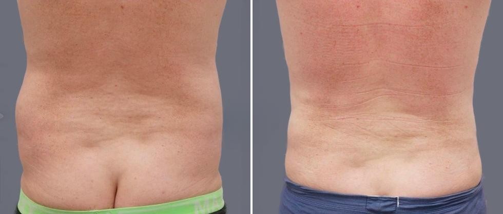 Vaser Back Liposcution Male Pre2024 018 Before And After